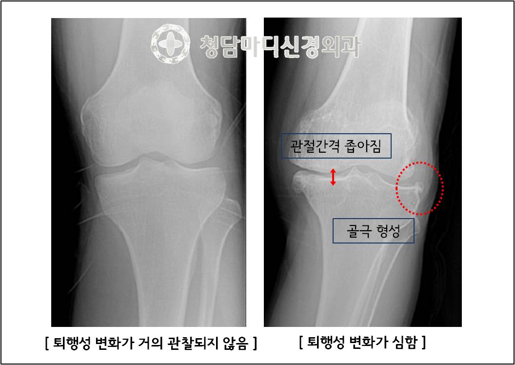 30대 여성 무릎 유리체 제거술 관절경 활막액 물청소 부산성모병원 입원 부산무릎잘하는곳 부산성형외과추천 6